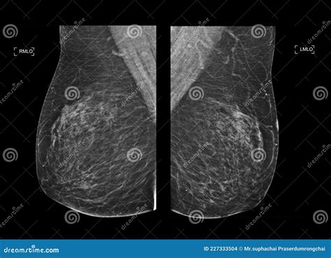 Effect of Digital Mammography for Breast Cancer .